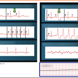 Arrhythmia arrhythmias cardiac ecg types