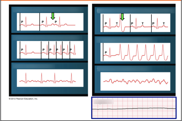 Arrhythmia arrhythmias cardiac ecg types