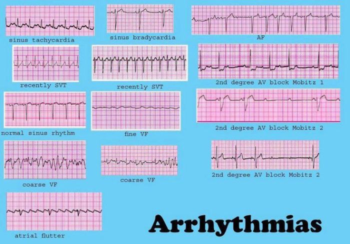 Label the following images illustrating cardiac arrhythmias