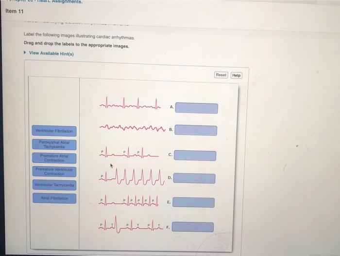 Label the following images illustrating cardiac arrhythmias