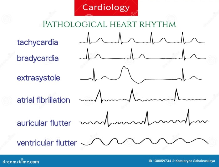 Ecg arrhythmias cardiac morphology preceding traces illustrating ventricular electrical sinus rhythms pvcs bbb asystole vf amplitude bradycardia eventual